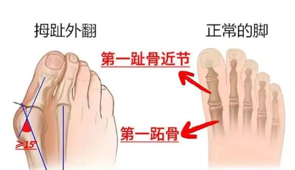 一直以为脚只是不好看，没想到居然是种病!